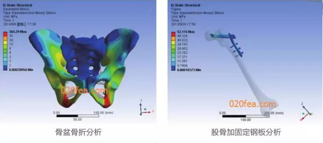 有限元分析法在结构、医学、流体与热及电场的分析与应用