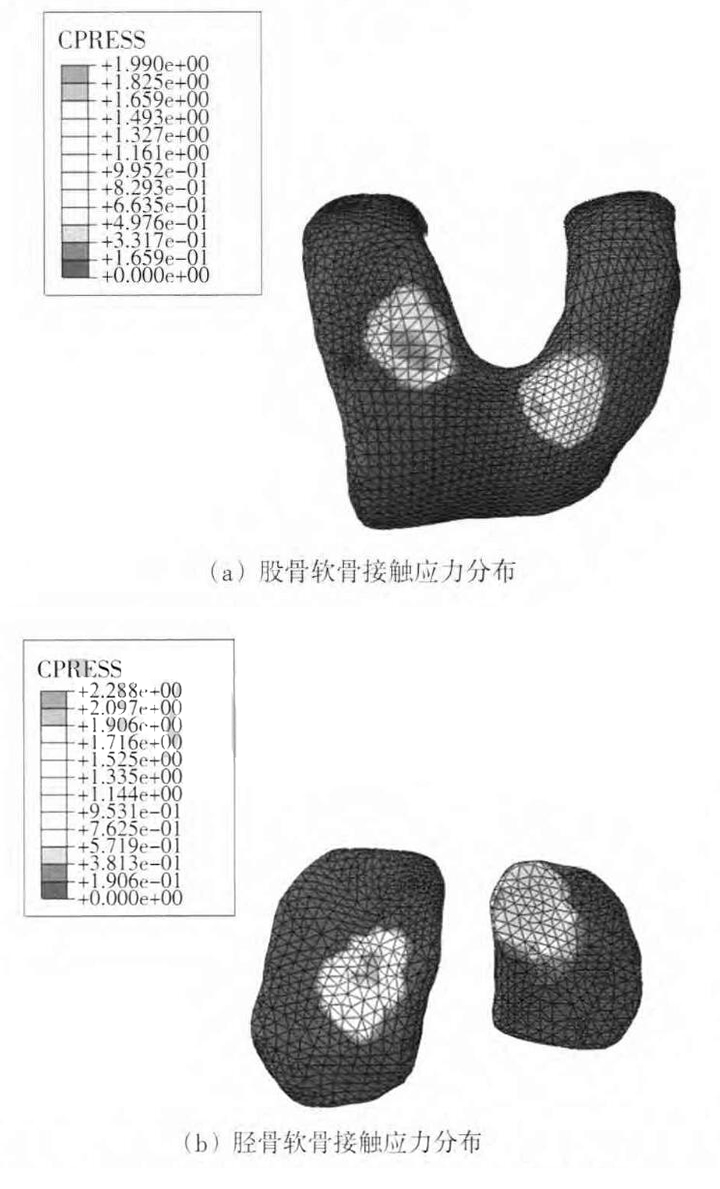 内马尔遭10次犯规 - 有限元助力膝关节保护及伤后恢复